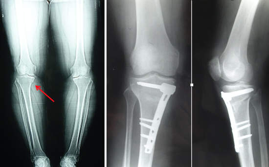 Picture 1: An osteotomy is performed to correct the bowing of the knee and unload the involved compartment Picture 1: An osteotomy is performed to correct the bowing of the knee and unload the involved compartment