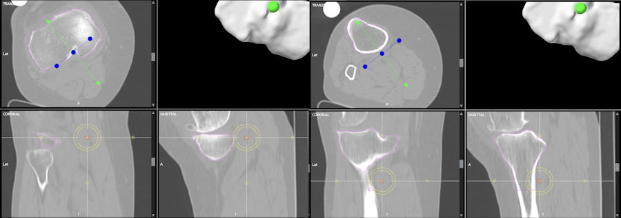Resim 2: Üç boyutlu bilgisayarlı tomografi ile robotik diz protezi planlaması. Resim 2: Üç boyutlu bilgisayarlı tomografi ile robotik diz protezi planlaması.