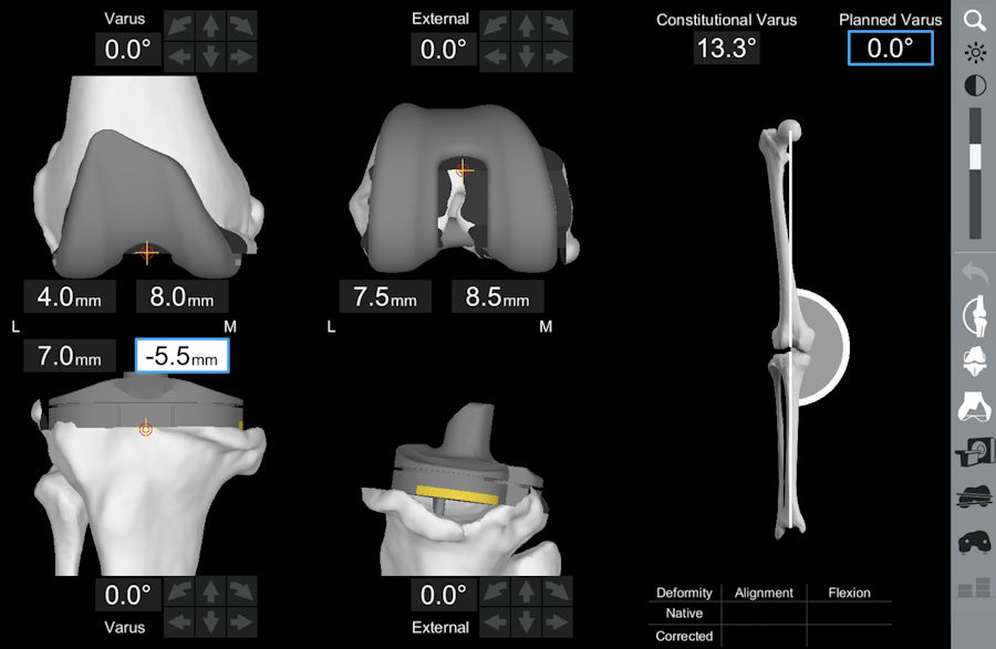 Resim 3: Robotik sistem ile 3 boyutlu planlama yapılarak istenen dizilim şekli elde edilebilir. Aşırı şekil bozukluğu ve kemik kaybı olan bu hastada mekanik dizilim tercih edilmiş. Resim 3: Robotik sistem ile 3 boyutlu planlama yapılarak istenen dizilim şekli elde edilebilir. Aşırı şekil bozukluğu ve kemik kaybı olan bu hastada mekanik dizilim tercih edilmiş.