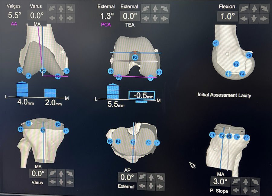 Resim 4: Bağ dengesi sağlanmadan önce planlanan kemik kesileri. Mekanik dizilim felsefesi uygulanırsa bağ dengesi sağlanamıyor. Resim 4: Bağ dengesi sağlanmadan önce planlanan kemik kesileri. Mekanik dizilim felsefesi uygulanırsa bağ dengesi sağlanamıyor.