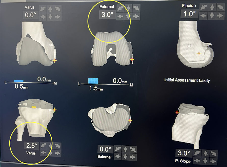 Resim 5: Resim 3’teki hastaya, fonksiyonel dizilim uygulanmış. Protez yerleşiminde yapılan birkaç derecelik açısal düzeltme ile bağ dengesi sağlanmış ve hastanın ameliyat öncesi dizilimi korunmuş. Resim 5: Resim 3’teki hastaya, fonksiyonel dizilim uygulanmış. Protez yerleşiminde yapılan birkaç derecelik açısal düzeltme ile bağ dengesi sağlanmış ve hastanın ameliyat öncesi dizilimi korunmuş.