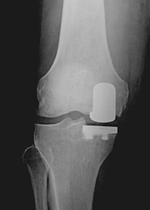 Resim 1b: Unikondiler diz protezinde eklemin sadece aşınmış olan kısmı protez ile kaplanmış.