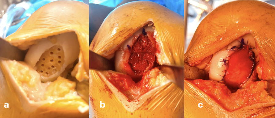 Resim 4: Geniş kıkırdak hasarı olan bir dizde matriks üzerine emdirilmiş kök hücre uygulaması; a: Hasarlı alanın hazırlanması, b: Hasarlı bölgenin tabanına kemik desteği yerleştirilmesi, c: Kemik desteğin üzerinin kök hücre emdirilmiş matriks ile örtülmesi. Aylar içinde bu bölgenin kıkırdağa dönüşmesi beklenmekte. Resim 4: Geniş kıkırdak hasarı olan bir dizde matriks üzerine emdirilmiş kök hücre uygulaması; a: Hasarlı alanın hazırlanması, b: Hasarlı bölgenin tabanına kemik desteği yerleştirilmesi, c: Kemik desteğin üzerinin kök hücre emdirilmiş matriks ile örtülmesi. Aylar içinde bu bölgenin kıkırdağa dönüşmesi beklenmekte.