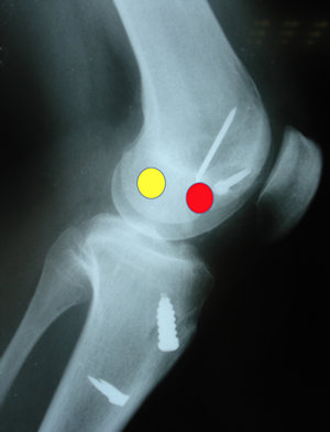 Resim 1: İlk ön çapraz bağ cerrahisi sırasında uygun olmayan tünel yerleşimi, kırmızı dair hatalı tünel girişi, sarı daire olması gereken yeri gösteriyor. Resim 1: İlk ön çapraz bağ cerrahisi sırasında uygun olmayan tünel yerleşimi, kırmızı dair hatalı tünel girişi, sarı daire olması gereken yeri gösteriyor.