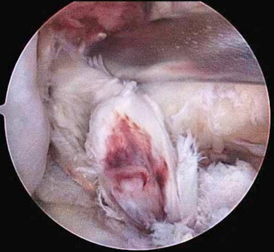 Resim 3 : Revizyon ön çapraz bağ cerrahisi sırasında bağ artıklarının temizlenmesi. Resim 3 : Revizyon ön çapraz bağ cerrahisi sırasında bağ artıklarının temizlenmesi.