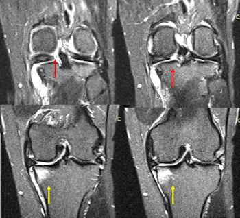 Resim 2: Menisküs kök yırtığında MRG bulguları. Kırmızı oklar: menisküs kökünün yapışma yerinden ayrılması; Sarı oklar:  eşlik eden kemik iliği ödemi.
