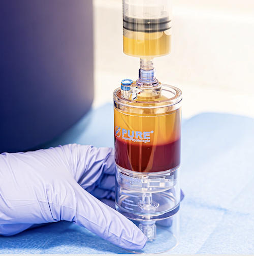 Kapalı sistem PRP kitlerine bir örnek; Emcyte supraphysiological Pure PRP kit. (Kaynak: https://emcyte.com/pureprp-sp/) Kapalı sistem PRP kitlerine bir örnek; Emcyte supraphysiological Pure PRP kit. (Kaynak: https://emcyte.com/pureprp-sp/)