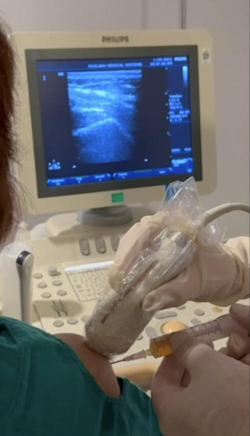 Resim 3: Omuz çevresi kaslardan birinde kısmi yırtık olan bir hastada ultrason eşliğinde hasarlı bölgeye PRP enjeksiyonu Resim 3: Omuz çevresi kaslardan birinde kısmi yırtık olan bir hastada ultrason eşliğinde hasarlı bölgeye PRP enjeksiyonu