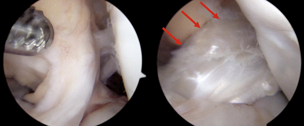 Resim 2: Ön çapraz bağ onarımının artroskopik görüntüsü, çocuğun kendi dokusu kullanılarak yeni bir bağ yapılmış. Resim 2: Ön çapraz bağ onarımının artroskopik görüntüsü, çocuğun kendi dokusu kullanılarak yeni bir bağ yapılmış.