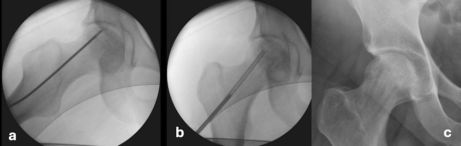 Resim 3: Femur başı avasküler nekrozunda kor dekompresyon ve greftleme ameliyatının basamakları. Hasarlı bölgeye skopi kontrolünde yerleştirilen kılavuz teli üzerinden (a) çoklu delikler açılır ve içeriye canlı kemik ve kök hücre konsantresi yerleştirilir (b). Bu tedavinin uygulandığı bir hastanın 1 yıl sonraki görüntüsü, başın yuvarlaklığı korunmuş ve çökme engellenmiş, kor dekompresyon tünellerine ait izler gözlenmekte (c). Resim 3: Femur başı avasküler nekrozunda kor dekompresyon ve greftleme ameliyatının basamakları. Hasarlı bölgeye skopi kontrolünde yerleştirilen kılavuz teli üzerinden (a) çoklu delikler açılır ve içeriye canlı kemik ve kök hücre konsantresi yerleştirilir (b). Bu tedavinin uygulandığı bir hastanın 1 yıl sonraki görüntüsü, başın yuvarlaklığı korunmuş ve çökme engellenmiş, kor dekompresyon tünellerine ait izler gözlenmekte (c).