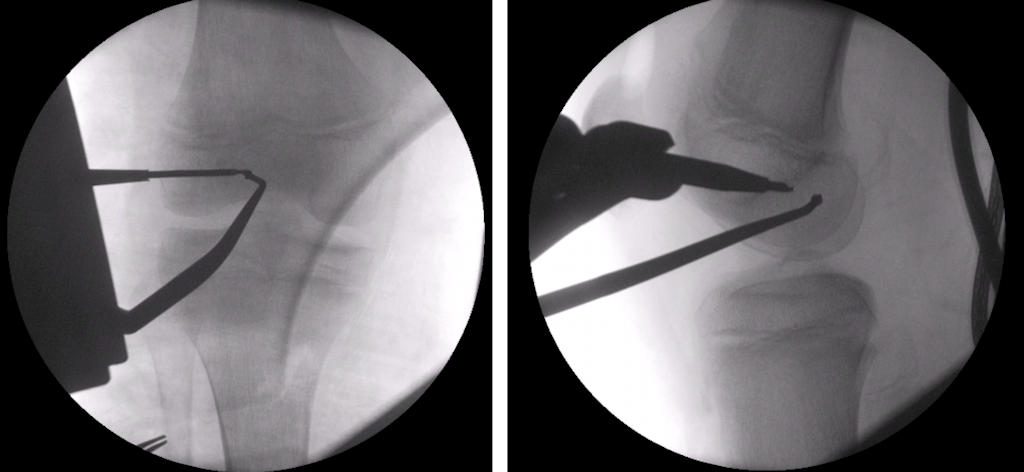 Resim 3: Büyüme kıkırdağı açık olan bir çocukta ameliyat sırasında skopi (röntgen) kontrolü altında ön çapraz bağ onarımı için uygun kemik tünellerin açılması. Resim 3: Büyüme kıkırdağı açık olan bir çocukta ameliyat sırasında skopi (röntgen) kontrolü altında ön çapraz bağ onarımı için uygun kemik tünellerin açılması.