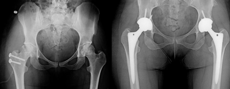 Resim 4 : Daha önceden baş koruyucu cerrahi uygulanmış ancak başın çökmesi engellenememiş bir hastada iki taraflı kalça protezi uygulanmış. Resim 4 : Daha önceden baş koruyucu cerrahi uygulanmış ancak başın çökmesi engellenememiş bir hastada iki taraflı kalça protezi uygulanmış.
