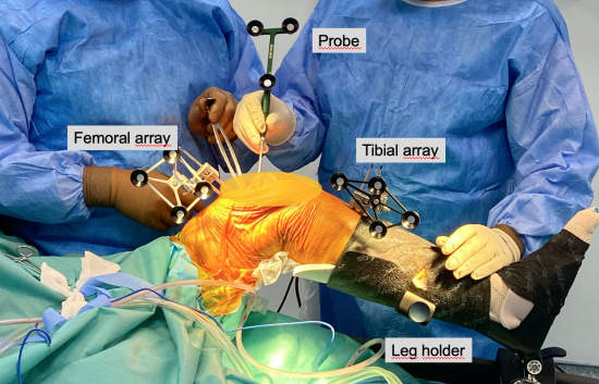 Picture 2: Placement of arrays and bone registration during surgery Picture 2: Placement of arrays and bone registration during surgery