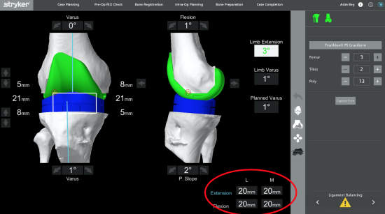 Picture 5: Evaluating soft tissue balance with the aid of the robotic system with trial components in place. Picture 5: Evaluating soft tissue balance with the aid of the robotic system with trial components in place.