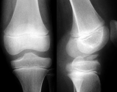 12 yaşında kız çocuğu, bisikletten düşme sonrası Tip III eminensiya kırığı 12 yaşında kız çocuğu, bisikletten düşme sonrası Tip III eminensiya kırığı